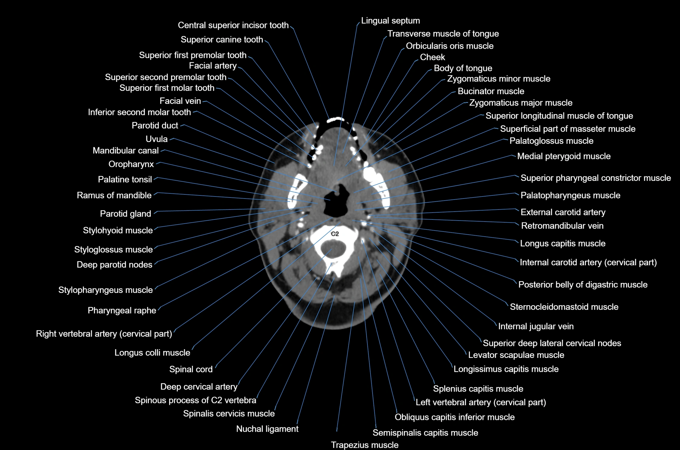 CT Neck axial cross sectional anatomy radiology image-img-00001-00027.webp
